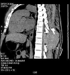 This diagnostic image is a sagittal CT scan of the dorsal spine, demonstrating a large spinal epidural hematoma. The imaging shows a localized, hyperdense collection (increased density) within the posterior extradural space at the thoracic level. This mass effect causes significant anterior displacement and compression of the spinal cord against the posterior aspect of the vertebral bodies. Anatomical landmarks include the thoracic vertebral column and the adjacent paraspinal tissues. Notably, the hematoma has displaced the overlying spinous process, pushing it posteriorly/superiorly from its normal alignment. This clinical finding is characteristic of an acute postoperative or traumatic complication, specifically a spinal epidural hematoma (SEH) resulting in spinal cord compression. The scan provides critical evidence for emergency surgical intervention, such as re-exploration and evacuation, to prevent permanent neurological deficit.