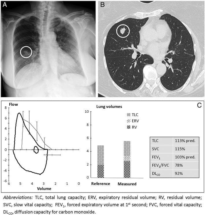 This composite educational graphic illustrates the diagnostic workup of a pulmonary nodule. Panel A is a posterior-anterior (PA) chest X-ray showing a focal, rounded opacity in the right mid-to-lower lung field, demarcated by a white circle. Panel B presents an axial high-resolution computed tomography (CT) slice of the chest, providing superior anatomical detail of the same nodule (circled), revealing its irregular morphology and heterogeneous density within the pulmonary parenchyma. Panel C details Pulmonary Function Test (PFT) results, featuring a flow-volume loop and bar graphs of lung volumes. The flow-volume loop shows a blunted expiratory limb and a shift toward higher volumes, while the bar graphs compare reference values to measured Total Lung Capacity (TLC), Expiratory Reserve Volume (ERV), and Residual Volume (RV). Accompanying data shows an elevated RV and SVC (115%), suggesting air trapping or expiratory muscle weakness. This image set is designed to teach the correlation between different thoracic imaging modalities and the physiologic assessment of lung function in patients with pulmonary lesions.