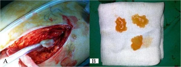 This composite clinical photograph depicts the intraoperative findings and macroscopic pathology of a hydatid cyst in a 56-year-old male. Image A shows an open surgical field in the proximal thigh, revealing a large incision with deep, erythematous soft tissue. A suction tube is visible within the wound, positioned near a whitish, gelatinous mass emerging from the muscular or bursa planes. Image B displays three macroscopic daughter vesicles or cysts placed on a sterile white gauze for examination. These vesicles are translucent, yellowish-amber in color, and possess a gelatinous texture. They exhibit a characteristic irregular, lobulated, or 'snow-shaped' morphology typical of Echinococcus granulosus infection. The educational focus is on the clinical presentation of musculoskeletal hydatid disease, which can mimic bursitis or soft tissue tumors around orthopedic implants. Key concepts illustrated include the visual identification of daughter cysts and the surgical management of cystic soft tissue masses in the extremities.