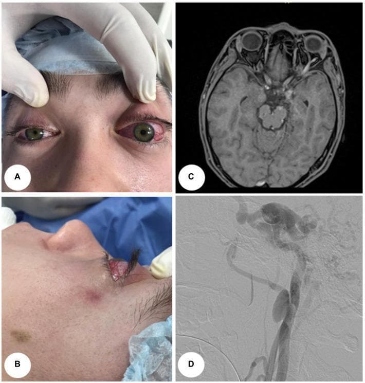 A multi-panel figure illustrating the clinical and radiological findings of a carotid-cavernous fistula (CCF). Panel A (anterior clinical photograph) and Panel B (lateral clinical photograph) show severe left-sided proptosis, conjunctival injection, and chemosis with visible protrusion of the swollen conjunctiva between the eyelids. Panel C is an axial MRI scan showing significant dilatation of the left superior ophthalmic vein (SOV) compared to the contralateral side, reflecting increased venous pressure. Panel D is a digital subtraction angiogram (lateral view) demonstrating a dural CCF with anterior and posterior drainage, occurring in conjunction with an extracranial internal carotid artery (ICA) aneurysm. The images collectively demonstrate the classical triad of clinical signs (pulsatile proptosis, chemosis, and orbital bruit) alongside definitive neuroimaging used for the diagnosis of high-flow or dural vascular shunts within the cavernous sinus, highlighting the correlation between orbital venous hypertension and intracranial vascular pathology.