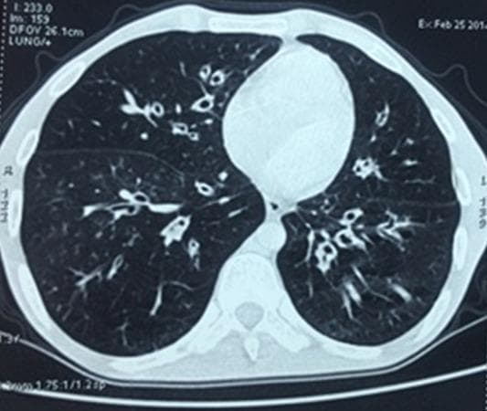 This diagnostic image is an axial chest CT scan using a lung parenchyma window, demonstrating significant pulmonary pathology. The primary finding is widespread, bilateral cylindrical bronchiectasis. Multiple dilated, thick-walled bronchi are visible throughout both lung fields, appearing as 'ring shadows' when viewed in cross-section and 'tram-track' signs where the airways are oriented parallel to the scan plane. The bronchial diameters clearly exceed those of their accompanying pulmonary arteries, a hallmark of bronchiectasis. The distribution is diffuse, affecting multiple lobes bilaterally. There are also subtle areas of bronchial wall thickening and small mucous plugs. These findings are characteristic of chronic obstructive or inflammatory airway disease, often associated with recurrent infections. In this clinical context, the structural damage is a secondary manifestation of Common Variable Immunodeficiency (CVID), reflecting the impact of humoral immune deficiency on long-term respiratory health and the development of permanent airway remodeling.