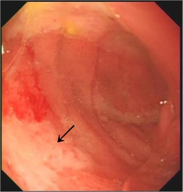 This gastroscopy image displays an active peptic ulcer located within the duodenal bulb. The endoscopic view reveals a prominent, irregular ulcerated lesion characterized by a thick, fibrinous white-yellowish exudate, colloquially referred to as 'white moss.' The surrounding duodenal mucosa exhibits significant pathological changes, including intense erythema (redness) and a granular, edematous texture, indicating localized inflammatory response. An arrow highlights the specific area of mucosal disruption and exudative deposition. This finding is clinically significant for diagnosing peptic ulcer disease and assessing the stage of ulcer healing or activity. The image serves as a clear educational example of upper gastrointestinal pathology for medical students and gastroenterology trainees focusing on diagnostic endoscopy.
