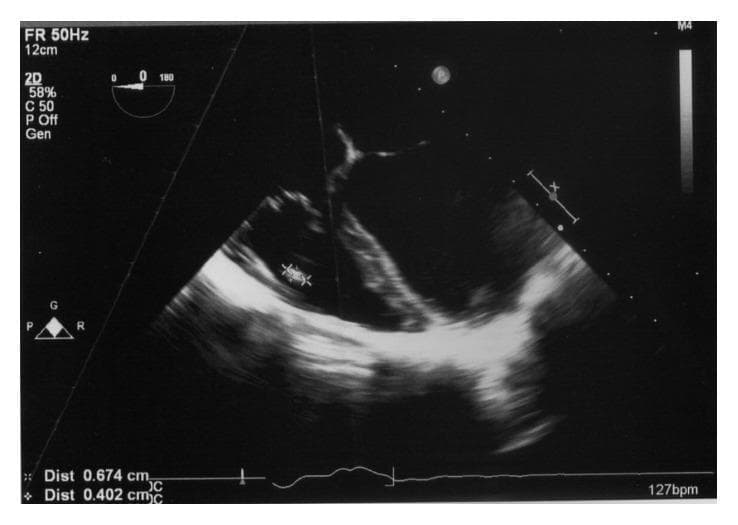 A grayscale diagnostic image from a transoesophageal echocardiogram (TOE) demonstrating a tricuspid valve vegetation in a patient with infective endocarditis. The image shows a mid-oesophageal four-chamber view focusing on the right side of the heart. A distinct, irregularly shaped, pedunculated mass measuring approximately 7 mm x 4 mm is visible, attached to the posterior leaflet of the tricuspid valve. This mass exhibits heterogeneous echogenicity, appearing more echodense than the surrounding blood pool but less uniform than the valve leaflet itself. Clinical significance includes the diagnosis of right-sided infective endocarditis, often associated in this context with pre-existing conditions like a ventricular septal defect (VSD). Key educational concepts illustrated include echocardiographic identification of valvular vegetations, assessment of mass size and mobility on heart valves, and the application of Duke's criteria for diagnosing endocarditis. The image provides critical visual evidence for managing structural heart disease and systemic infection.