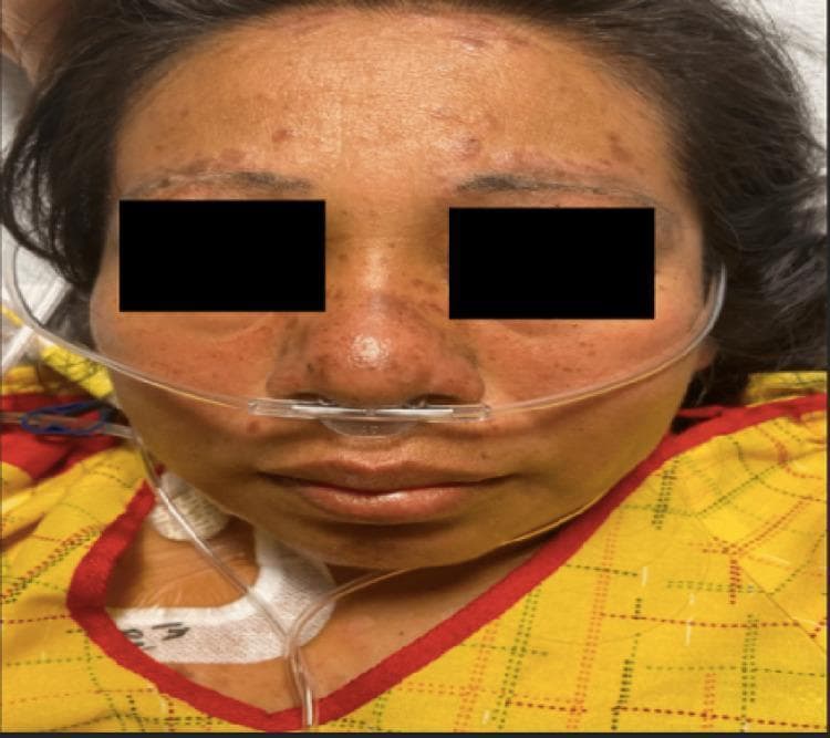A clinical photograph of a female patient's face demonstrating classic dermatological manifestations of systemic lupus erythematosus (SLE). A confluent, erythematous malar rash is visible in a characteristic 'butterfly distribution,' spanning the bridge of the nose and both cheeks. Notably, the nasolabial folds are spared from the erythema. In addition to the malar rash, there are multiple discrete, raised, hyperpigmented, and round discoid lesions located along the hairline and eyebrows, suggesting discoid lupus involvement. Mild peri-orbital edema is present. The patient is shown with a nasal cannula in place, indicating respiratory support, consistent with potential systemic complications such as pleural effusion. This image serves as a teaching tool for identifying pathognomonic skin signs of autoimmune connective tissue diseases, specifically highlighting the distinction between the malar rash and lesions that involve the forehead and scalp.