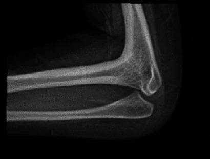 This diagnostic X-ray (radiography) captures a lateral view of a human elbow joint, illustrating a congenital or acquired radiohumeral synostosis. The image demonstrates a clear bony fusion between the distal humerus and the proximal head of the radius. Specifically, there is a total lack of a visible joint space at the radiohumeral articulation, with continuous cortical and trabecular bone spanning the two structures. In contrast, the ulnohumeral articulation appears relatively spared, with a discernible joint space maintained between the trochlea of the humerus and the trochlear notch of the ulna. The olecranon process of the ulna is visible posteriorly. This radiographic finding is clinically significant as a manifestation of rare skeletal dysplasias or as a solitary orthopedic anomaly, leading to a complete loss of pronation and supination at the forearm. The image serves as a textbook example for orthopedic and radiological training in identifying joint fusion and anomalous skeletal developments.