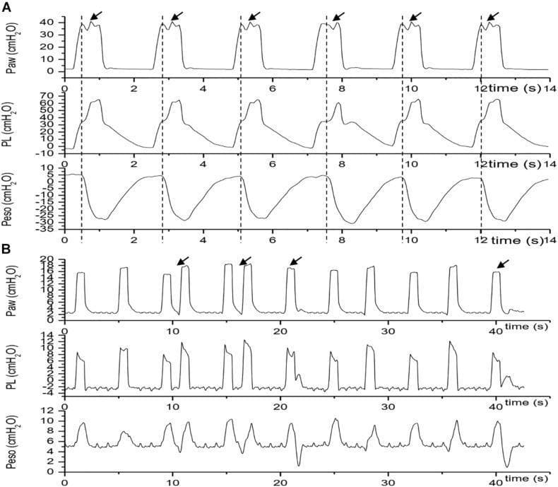 This diagnostic graphic displays respiratory waveform traces illustrating reverse trigger (RT) phenomena in patients under mechanical ventilation. The figure is divided into two panels, A and B, each showing three concurrent pressure-time waveforms: airway pressure (Paw), transpulmonary pressure (PL), and esophageal pressure (Peso), measured in cmH2O. Panel A demonstrates 'stable' reverse triggering with a 1:1 entrainment ratio over 14 seconds. Vertical dashed lines mark the initiation of mechanical breaths, followed by arrows indicating subsequent negative fluctuations in Peso, which represent delayed patient effort (reverse triggering) causing secondary pressure rises in Paw and PL. Panel B depicts 'unstable' reverse triggering over a 40-second period, characterized by irregular entrainment ratios and erratic Peso fluctuations. These traces serve as a clinical tool for identifying patient-ventilator dyssynchrony, specifically the mid-cycle and late RT phenotypes. The visual highlights how reflex-mediated diaphragmatic contraction follows a ventilator-delivered breath, potentially increasing transpulmonary pressure and the risk of lung injury.