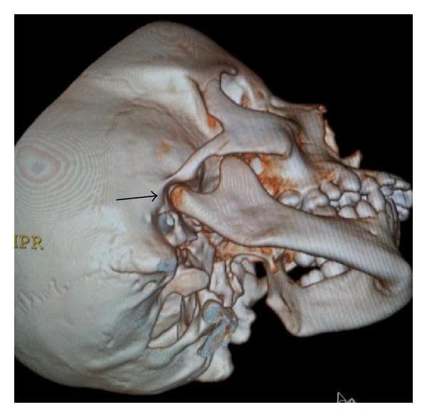 This diagnostic image is a 3D computed tomography (CT) reconstruction of a human skull, providing a lateral-oblique view of the right craniofacial region. The visualization highlights the normal anatomy of the temporomandibular joint (TMJ). A black arrow indicates the right mandibular condyle, which exhibits a smooth, rounded cortical surface and maintains a proper anatomical relationship with the glenoid fossa of the temporal bone. Key visible structures include the mandible, maxilla with developing mixed dentition, zygomatic bone, and the temporal bone. The image serves as a healthy baseline comparison for evaluating maxillofacial asymmetries or developmental pathologies like condylar aplasia. This anatomical diagram is highly relevant for dentistry and oral and maxillofacial surgery education, demonstrating the standard structural integrity and alignment of the TMJ components.