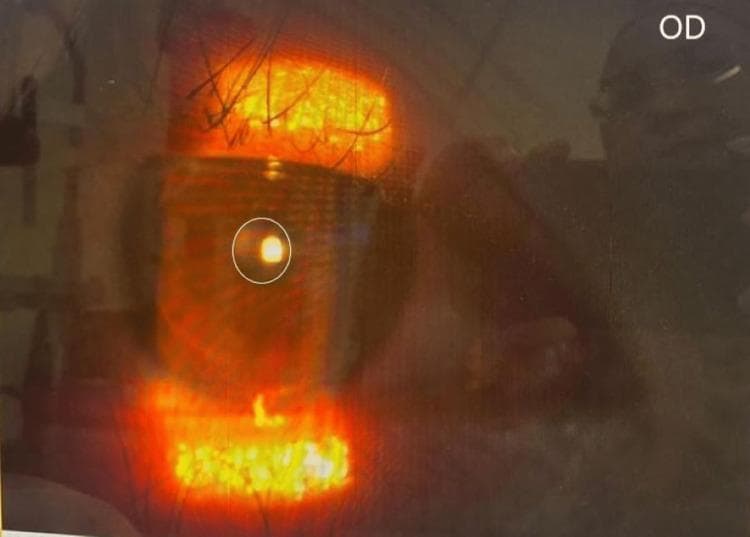 A close-up clinical photograph of the right eye (oculus dexter, OD) under examination, demonstrating miosis. The image highlights a constricted pupil, approximately 2 mm in diameter, which is circular and displays a sharp corneal light reflex from the slit lamp or illumination source. The iris is visible but partially obscured by reflection. The image is used to document clinical findings in Horner's syndrome, specifically pupillary asymmetry (anisocoria) where the affected eye exhibits miosis. The photograph provides a clear visual of the anterior segment focusing on pupillary size and reactivity for diagnostic purposes in neuro-ophthalmology. Key educational concepts include the assessment of the oculosympathetic pathway and the identification of post-surgical Horner's syndrome manifestations.