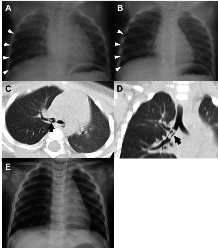 This composite figure illustrates a pediatric case of airway foreign body aspiration through chest X-rays (CXR) and computed tomography (CT) scans. (A, B) Serial frontal chest radiographs compare expiratory and inspiratory phases; white arrowheads indicate localized air trapping and hyperinflation in the right lower lung field, characteristic of a check-valve obstruction. (C) Axial chest CT image demonstrates a small, low-density, cylindrical foreign body (black arrow) lodged within the right inferior lobar bronchus, partially obstructing the lumen. (D) Coronal CT reconstruction provides a longitudinal view of the 'seven-shaped' plastic foreign body (black arrow) within the bronchial tree, highlighting its anatomical relationship to the branching airways. (E) Post-procedural frontal CXR shows resolution of the right-sided emphysema and normal lung expansion following the successful removal of the object via bronchoscopy. This series demonstrates the diagnostic utility of dynamic expiratory radiography and CT in identifying radiolucent foreign bodies in pediatric patients.