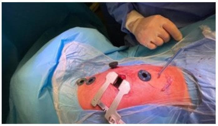 This clinical photograph displays the surgical field of a Video-Assisted Thoracoscopic Surgery (VATS) for spinal vertebral body tethering. The thoracic region of a patient in a lateral decubitus position is shown, prepped with an adhesive incise drape. A central mini-thoracotomy incision (approximately 5 cm) is held open by a self-retaining muscle-sparing retractor. Surrounding the primary incision are multiple surgical ports: three 5-mm trocars are placed along the anterior axillary line to facilitate instrumentation, and one larger 10-mm port is positioned medially for a 30-degree thoracoscopic camera. The strategic arrangement of these ports between the fourth and eighth intercostal spaces allows for multi-level access to the thoracic spine. A surgeon's gloved hand is visible in the upper right quadrant, and a single surgical instrument is seen entering a port site. This setup illustrates the hybrid approach combining direct visualization through a small incision with thoracoscopic assistance for minimally invasive orthopedic spinal correction.