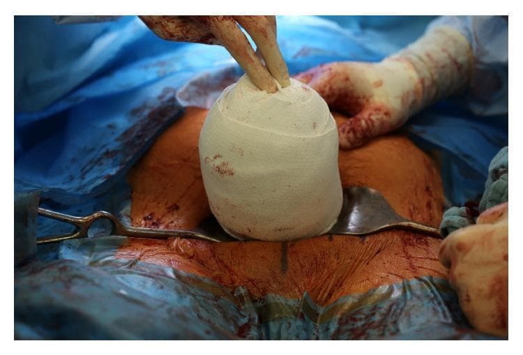 This clinical photograph shows an intraoperative view of an exteriorized uterus during a surgical procedure, specifically illustrating the management of uterine atony. The uterus is tightly wrapped in a white, woven compression bandage, forming a spherical or ovoid shape. This technique, known as the uterine sandwich or a variation of external compression, is used to control postpartum hemorrhage when uterotonics fail. The bandaged organ is positioned centrally within the surgical field, which is draped with blue sterile cloths. Visible landmarks include blood-stained abdominal skin and surgical instruments, including a metal retractor (likely a Doyen or Fritsch retractor) positioned beneath the exteriorized uterus and a surgical clamp on the left. Gloved hands of the surgical team are visible, applying manual pressure to the top of the wrapped uterus. This image serves as an educational resource for obstetricians and surgical residents on mechanical hemostatic techniques during cesarean delivery complications.