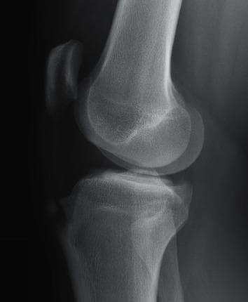 This lateral view X-ray radiography of the knee joint demonstrates the characteristic features of Osgood-Schlatter disease. The imaging focuses on the proximal tibia, distal femur, and patella. A prominent, irregular bony enlargement is visible at the tibial tuberosity, which serves as the insertion site for the patellar ligament. This area shows significant anterior protrusion and evidence of bony fragmentation, with small ossicles or fragments separated from the main tibial cortex. The surrounding bone tissue exhibits mild sclerosis. The joint space and patellar positioning appear otherwise normal. This diagnostic image is representative of chronic traction apophysitis in an adolescent patient, illustrating the sequelae of repetitive stress on the tibial tubercle apophysis. It serves as an educational example for orthopedic radiology, particularly in the context of pediatric sports medicine and growth-related musculoskeletal conditions.