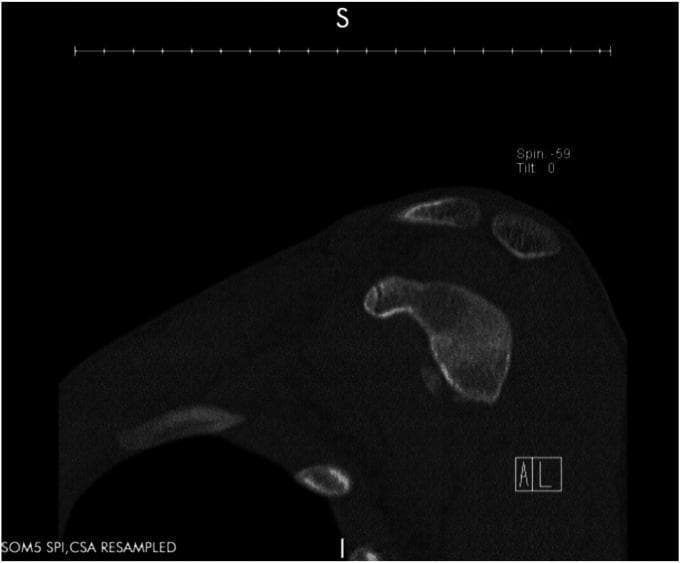 This diagnostic image is a sagittal Computed Tomography (CT) scan of the shoulder region, specifically demonstrating the glenohumeral anatomy. The image focuses on the glenoid fossa of the scapula, showing bone density and morphology. A significant structural abnormality is visible along the anterior-inferior aspect of the glenoid rim. There is a clear discontinuity and irregularity in the cortical bone contour, consistent with a bony Bankart lesion. This finding indicates an avulsion fracture of the anteroinferior glenoid margin, typically resulting from an anterior shoulder dislocation. The acromion and coracoid processes are visible superiorly, providing anatomical orientation. This imaging is clinically significant for evaluating glenoid bone loss and stability in patients with recurrent shoulder instability. The neutral gray tones represent varying tissue densities, with the bright white areas indicating the cortical and trabecular bone of the scapular spine and glenoid.