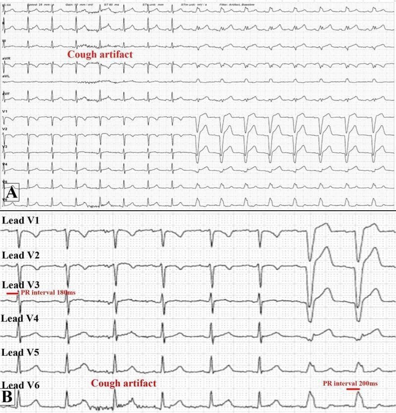 This diagnostic image is a 12-lead electrocardiogram (ECG) demonstrating the phenomenon of phase 4 (bradycardia-dependent) left bundle branch block (LBBB) triggered by a cough. Panel A shows a standard 12-lead tracing (I, II, III, aVR, aVL, aVF, V1-V6). A 'cough artifact' is annotated in the rhythm strip, immediately followed by a transition from narrow QRS complexes to wide QRS complexes with a LBBB morphology. Panel B provides a zoomed-in view of the precordial leads V1-V6, highlighting the specific conduction changes. It documents an increase in the PR interval from 180 milliseconds (associated with narrow QRS complexes) to 200 milliseconds (associated with wide QRS complexes) following the cough. The morphology transition is most evident in leads V1 and V2 (deep S-waves) and lead V6 (monophasic R-wave). This tracing illustrates an uncommon mechanism where a physiological maneuver (coughing) alters cardiac conduction timing, leading to a rate- or pause-dependent bundle branch block during a myocardial perfusion stress test protocol.
