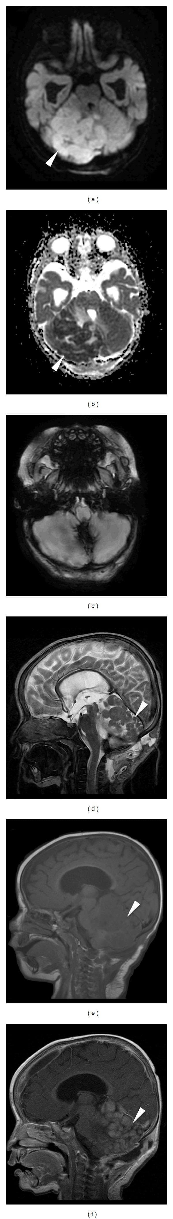 This composite of brain MRI sequences illustrates a Medulloblastoma with Extensive Nodularity (MBEN) in the posterior fossa. (a) Axial Diffusion-Weighted Imaging (DWI) and (b) Apparent Diffusion Coefficient (ADC) map demonstrate restricted diffusion within the mass, typical of highly cellular tumors. (c) Axial Susceptibility-Weighted Imaging (SWI) shows minor susceptibility artifacts. (d) Sagittal T2-weighted sequence highlights the hallmark 'grape-like' morphology, with numerous hyperintense, well-circumscribed nodules. (e) Sagittal pre-contrast T1-weighted image shows the mass as predominantly hypointense relative to the cerebellum. (f) Sagittal post-gadolinium T1-weighted image reveals significant enhancement of the nodular components, making the multicystic or multinodular internal architecture more prominent. The lesion is located in the cerebellum and vermis, causing mass effect on the fourth ventricle. These radiological features are characteristic of the MBEN variant of medulloblastoma, often seen in infants and associated with a relatively favorable prognosis.