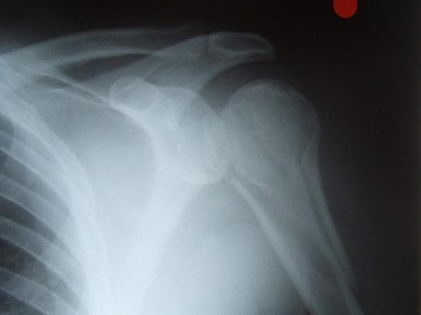 Anteroposterior (AP) view X-ray of the left shoulder demonstrating a complex, comminuted fracture of the proximal humerus. The radiograph reveals multiple fracture lines involving the anatomical neck and humeral head, extending into the proximal shaft. There is significant cortical disruption and misalignment of fragments, consistent with an iatrogenic fracture following a manipulation attempt. The humeral head shows loss of normal congruence with the glenoid fossa, suggesting an associated glenohumeral dislocation or subluxation. Surrounding structures visible include the clavicle, acromion, scapula, and superior ribs, which appear radiographically intact. This image serves as a clinical example of potential complications during the reduction of shoulder dislocations, illustrating the importance of accurate pre-procedural diagnosis of fracture-dislocations in orthopaedic trauma.