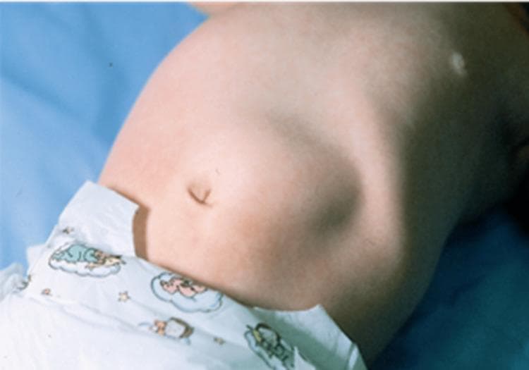 This clinical photograph displays the abdominal region of an infant in a supine position, highlighting a distinct physical examination finding. A visible, localized bulge is evident in the right upper quadrant (RUQ), situated superior and lateral to the centrally located umbilicus. This protrusion represents the classically described 'olive-like' mass associated with Infantile Hypertrophic Pyloric Stenosis (IHPS). The abdominal contour exhibits asymmetry due to this mass and a generalized epigastric fullness, which may indicate gastric distension proximal to the pyloric obstruction. The skin appears intact with fair pigmentation and no signs of acute inflammation or surgical scarring. A small, incidental white macule is visible on the upper right thoracic-abdominal junction. This image serves as a key pedagogical example for pediatric physical diagnosis, illustrating the visible signs of a thickened pyloric muscle and subsequent mechanical gastric outlet obstruction.