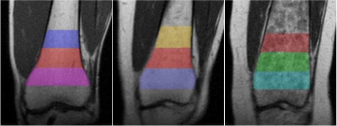 This diagnostic image consists of three coronal MRI slices of the distal femur, illustrating the spectrum of Erlenmeyer flask deformity (EFD) severity. The panels show varying degrees of metaphyseal remodeling: 'No EFD' (left), 'Mild EFD' (center), and 'Severe EFD' (right). Each image features three superimposed, color-coded Regions of Interest (ROIs) used for volumetric and morphometric analysis. The ROIs are segmented based on distance from the physis: 0–2 cm, 2–4 cm, and 4–6 cm proximally. Visually, the progress from left to right demonstrates a loss of the normal concave 'waist' transition from the metaphysis to the diaphysis. In the 'Severe EFD' case, there is pronounced metaphyseal flaring and cortical thinning, resulting in a characteristic bulbous shape associated with skeletal dysplasias or metabolic bone diseases such as Gaucher disease or osteopetrosis. The image serves as a comparison chart for diagnostic staging and quantitative assessment of bone morphology using medical imaging software.