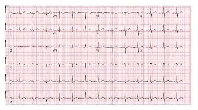 A standard 12-lead electrocardiogram (ECG) printed on pink grid paper, presenting a normal sinus rhythm at a rate of approximately 75 beats per minute. The tracing displays leads I, II, III (limb leads); aVR, aVL, aVF (augmented leads); and V1 through V6 (precordial leads). Each narrow QRS complex is preceded by a distinct, upright P wave in leads I, II, and aVF, signifying regular sinoatrial node conduction. The PR and QT intervals appear within normal physiological limits, and the QRS duration is not prolonged. T waves are concordant with the QRS complexes in the lateral leads, and there is no evidence of ST-segment elevation or depression, indicating an absence of acute ischemic changes. This ECG represents a stable postoperative cardiac rhythm following a permanent pacemaker implantation, demonstrating successful restoration of a regular heart rate and rhythm.