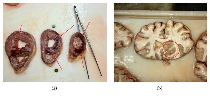 This composite educational image presents two gross pathology specimens from a clinical autopsy. Panel (a) displays transverse cross-sections of the heart, specifically the ventricles. Red arrows indicate extensive areas of acute myocardial infarction characterized by dark, congested, and hemorrhagic zones alongside pale, ischemic tissue involving the right ventricle and the interventricular septum. Panel (b) shows a coronal section of the brain. A red circle highlights a localized area of acute cerebral infarction. This region exhibits structural disruption and a subtle grayish-tan discoloration compared to the surrounding healthy gray and white matter. The clinical context for these findings is systemic gas embolism (GE) leading to simultaneous multi-organ vascular obstruction and subsequent infarction. The image demonstrates the catastrophic consequences of arterial air embolism on high-demand metabolic tissues like the myocardium and cerebral parenchyma, serving as an advanced resource for pathology and emergency medicine education.