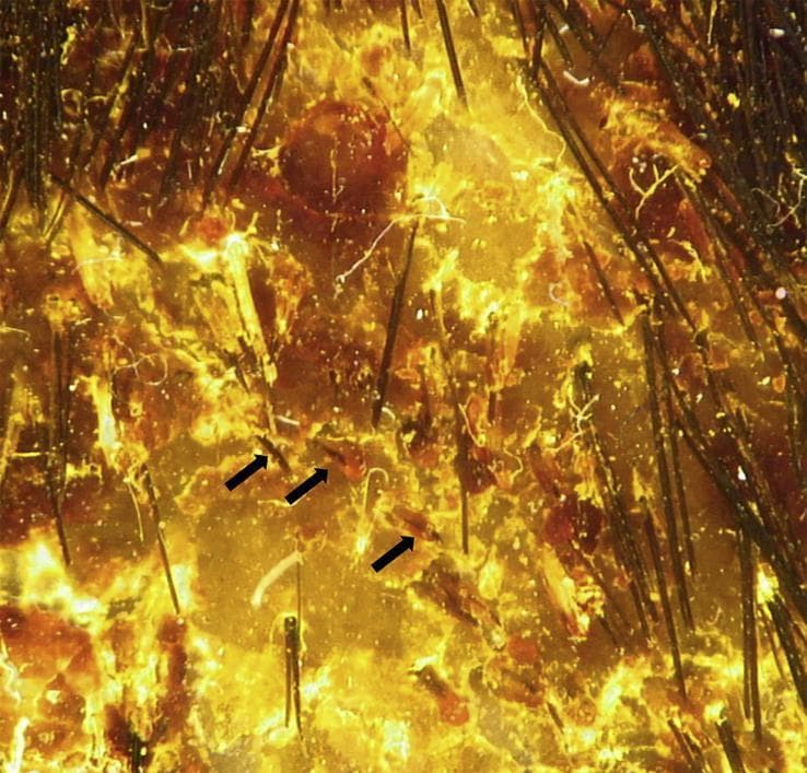 This diagnostic image is a high-magnification dermoscopy of the scalp, illustrating classic features of inflammatory tinea capitis (kerion). The clinical findings include prominent, ill-defined patches of erythema and thick, yellowish-white diffuse scaling (scales) across the scalp surface. Notable trichoscopic markers of fungal infection are present, specifically 'comma hairs'—short, fractured hair shafts that exhibit a distinctive curved, comma-like morphology (indicated by black arrows). Additionally, the field shows several dystrophic broken hairs and the presence of white hair casts (perifollicular keratin cylinders) encircling proximal hair shafts. These features are highly suggestive of ectothrix fungal invasion and are utilized in clinical dermatology to differentiate tinea capitis from other forms of alopecia or inflammatory scalp conditions. The image demonstrates key diagnostic indicators for medical students and clinicians specializing in dermatology and infectious diseases.
