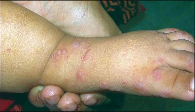 Clinical photograph of a pediatric patient's lower extremity, focusing on the dorsum of the foot and distal lower leg. The image shows a scattered papulovesicular eruption characteristic of Hand, Foot, and Mouth Disease (HFMD). The lesions consist of multiple small (approximately 3-10mm) erythematous papules and clear to gray-tinged fluid-filled vesicles. Many lesions exhibit a distinct peripheral erythematous halo. The vesicles are varied in morphology, appearing round, oval, or elongated. There is a higher concentration of lesions across the dorsal surface of the foot and extending toward the anterior ankle and distal leg. No secondary changes such as crusting, ulceration, or honey-colored scaling are visible. The clinical presentation is consistent with a viral exanthem, specifically Coxsackievirus or Enterovirus infection, which typically manifests as vesiculobullous lesions in specific acral and oral distributions.