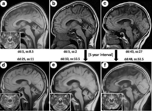 This diagnostic imaging panel presents a series of brain MRI scans illustrating progressive cerebellar atrophy in Spinocerebellar Ataxia Type 13 (SCA13). The primary images are T1-weighted midline sagittal sections (a-f), accompanied by T2-weighted axial insets (a, d, e, f). The sagittal views demonstrate varying degrees of cerebellar vermis shrinkage and enlargement of the pericerebellar CSF spaces. Notably, while the cerebellum shows marked volume loss particularly in long-duration cases (d and f), the brainstem and pons appear relatively preserved. The axial insets highlight widening of the cerebellar fissures and thinning of the folia, characteristic of global cerebellar atrophy. Serial scans for two patients (b to e; c to f) taken over a 5-year interval show subtle radiographic progression despite clinically significant increases in Scale for Assessment and Rating of Ataxia (SARA) scores. The images correlate disease duration (dd) and clinical severity (ss) with structural neuroanatomical changes, serving as an educational resource for identifying isolated cerebellar neurodegeneration.