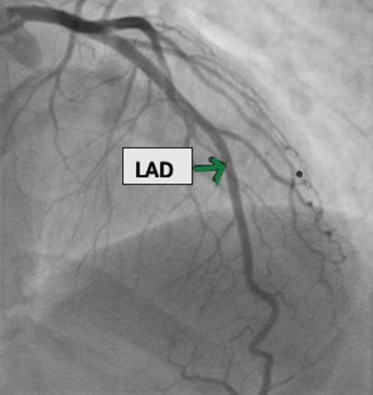 This diagnostic image is a coronary angiogram captured in an anteroposterior (AP) cranial projection, focusing on the left coronary system. The primary anatomical structure shown is the Left Anterior Descending (LAD) artery, which is explicitly identified with a green arrow and text label. The vessel is opacified with radiopaque contrast media, allowing for the visualization of its lumen and various septal and diagonal branches. Morphologically, the LAD appears to have a smooth course with no evidence of significant atherosclerotic stenosis, obstructive lesions, or filling defects, consistent with normal coronary anatomy. The distal vasculature shows normal tapering. The image serves as an educational example of cardiac catheterization imaging used to evaluate coronary artery disease and vessel patency. The background displays the hazy silhouette of the cardiac apex and diaphragm, typical of standard fluoroscopic imaging during an invasive cardiac procedure.