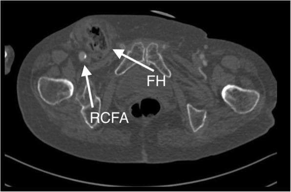 This diagnostic image is a transverse (axial) cross-section from a Computed Tomography Angiography (CTA) scan of the pelvic and groin region. The image illustrates the spatial anatomy of a right-sided femoral hernia (FH). A white arrow labeled 'RCFA' points to the right common femoral artery, which is visualized as a bright, contrast-enhanced circular structure. Medial to the RCFA, a second white arrow labeled 'FH' identifies the femoral hernia sac protruding through the femoral canal. The hernia sac contains convoluted soft tissue consistent with small bowel loops; the presence of contrast within these loops indicates maintained perfusion and the absence of acute strangulation at the time of imaging. Surrounding anatomical landmarks include the pelvic girdle bones (ilium and pubic symphysis) and the proximal femurs. This visual is clinically significant for demonstrating the relationship between vascular structures and hernial protrusions in the groin, serving as a critical diagnostic tool for pre-surgical planning in complex patients.