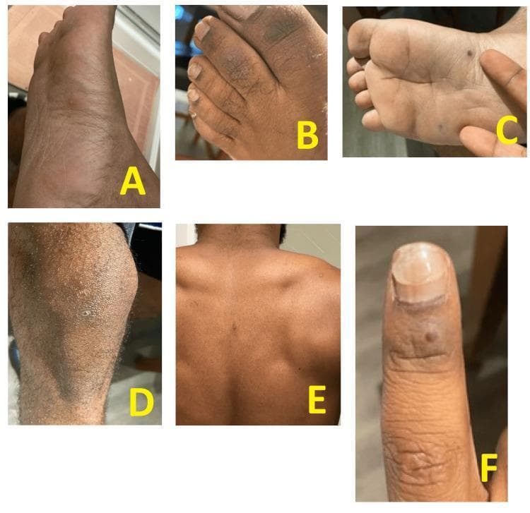 Six clinical photographs (labeled A-F) demonstrate a disseminated maculopapular exanthem and isolated pustules on a patient with dark skin. Images A, B, and C focus on the feet, showing scattered erythematous papules and distinct small, dark-colored pustules on the plantar surface and toes. Image D shows a diffuse erythematous maculopapular rash on the lower leg with interspersed small pustules. Image E displays sparse, individual papules across the back, and image F highlights a solitary papule on the dorsal aspect of a finger near the nail. The lesions are non-grouped and vary from small, raised red bumps (papules) to darker, fluid-filled elevations (pustules). The distribution is widespread, involving the palms, soles, extremities, and trunk. This clinical presentation is characteristic of systemic infectious processes, such as secondary syphilis or viral exanthems (e.g., mpox), and is useful for teaching dermatologic manifestations of systemic disease in diverse skin phototypes.