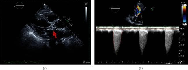 Transthoracic echocardiogram (TTE) composite demonstrating severe degenerative calcific aortic stenosis. Panel (a) shows a 2D parasternal long-axis view where a red arrow highlights the aortic valve, which exhibits bulky, hyperechoic echoes consistent with dense calcification and restricted leaflet mobility. Panel (b) presents an apical five-chamber view with continuous-wave Doppler (CWD) across the aortic valve. The spectral Doppler signal displays a dense, late-peaking parabolic envelope with high velocities reaching approximately 5.5 m/s and a calculated mean transvalvular gradient of 48 mmHg, diagnostic of severe aortic stenosis. A small color Doppler flow map is visible in the upper portion of panel (b), showing high-velocity aliasing at the valve level. The images illustrate key diagnostic criteria for valvular heart disease and hemodynamic assessment in geriatric cardiology.