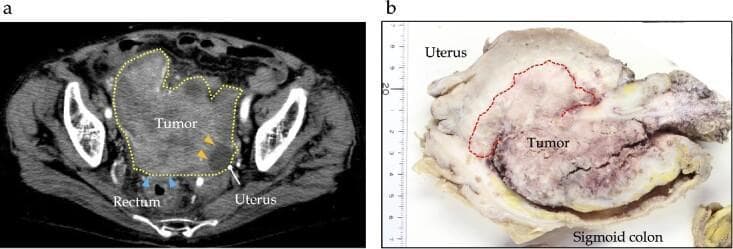 Educational medical composite featuring preoperative imaging and gross pathology of a sigmoid colon carcinoma. Panel (a) is an axial contrast-enhanced CT scan of the pelvis showing a large, heterogeneous, hypodense mass approximately 12 cm in diameter (delineated by a yellow dotted line). The imaging demonstrates suspicion of direct invasion into the adjacent rectum (blue arrows) and uterus (yellow arrows). Panel (b) shows a macroscopic photograph of the resected surgical specimen alongside a measurement scale. The specimen contains the sigmoid colon and uterus, revealing a bulky, irregularly shaped Type 1 tumor (outlined with a red dotted line) measuring 130 x 40 x 25 mm. The gross findings confirm direct local invasion into the uterine corpus, ovary, and small intestine. This case illustrates clinical Stage IIC (T4bN0M0) colorectal adenocarcinoma, emphasizing the visual characteristics of locally advanced disease and the importance of multidisciplinary surgical planning for multi-organ resection.