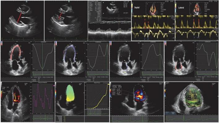 A multi-panel echocardiographic compilation demonstrating advanced cardiac imaging modalities. The top row illustrates conventional echocardiography, including 2D grayscale parasternal long-axis views with diameter measurements, M-mode tracings for ventricular wall motion assessment, and pulsed-wave Doppler for mitral inflow and tissue Doppler imaging for septal/lateral annular velocities. The middle row showcases Speckle-Tracking Echocardiography (STE), depicting apical four-chamber views with color-coded myocardial strain overlays and associated longitudinal strain/strain-rate curves, used to quantify regional and global myocardial deformation. The bottom row presents Vortex Flow Mapping (VFM) and intraventricular pressure gradient analysis. These panels visualize intracavitary hemodynamics using color-coded vector maps, vorticity contours, and energy loss distributions within the left ventricle. Quantitative graphs accompany these images, displaying flow velocity and pressure profiles across the cardiac cycle. The composite serves as an educational overview of integrated cardiac mechanics and hemodynamics, relevant for the advanced assessment of heart failure and ventricular function.