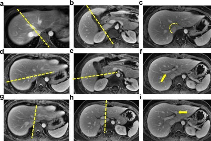 This set of axial MRI images illustrates the application of Couinaud's hepatic classification system for segmenting liver anatomy. The images use dashed yellow lines and arrows to demonstrate the five primary planes (three vertical and two horizontal) defined by vascular landmarks. Panels (a) and (b) show the line from the middle hepatic vein (MHV) to the inferior vena cava (IVC) or gallbladder fossa, separating the right and left lobes. Panels (d) and (e) depict the right hepatic vein (RHV) plane, which further divides the right lobe into anterior and posterior segments. Panels (g) and (h) demonstrate the left hepatic vein (LHV) and left longitudinal fissure, which distinguish the medial and lateral segments of the left lobe. Horizontal division into superior and inferior segments is marked by the portal vein branches (f and i). Additionally, panel (c) highlights the curved boundary of the caudate lobe (Segment I). This visualization is a critical tool for surgical planning and radiological reporting in abdominal imaging.