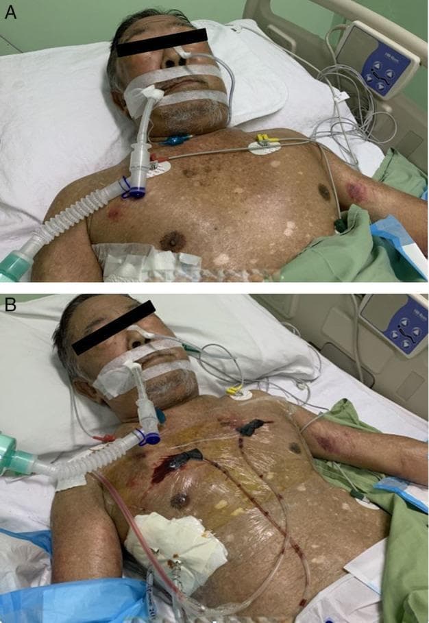 Two-panel clinical photograph illustrating the management of extensive subcutaneous emphysema (SE). Image A shows an elderly male patient with severe swelling and distension of the face, neck, and upper torso, secondary to trapped air in the subcutaneous tissues (subcutaneous emphysema). The patient is intubated with an endotracheal tube secured for airway protection due to compromise from tissue tension. Image B, taken 24 hours later, demonstrates a significant reduction in soft tissue swelling following the placement of subcutaneous negative pressure wound therapy (NPWT). Two incision sites are visible on the anterior chest wall (bilateral infraclavicular region) where subcutaneous drains are inserted and secured under transparent occlusive dressings. The chest also shows an existing surgical dressing on the right lower quadrant and cardiac monitoring leads. This comparison highlights a surgical intervention technique for rapidly decompressing life-threatening subcutaneous emphysema when conventional drainage fails.