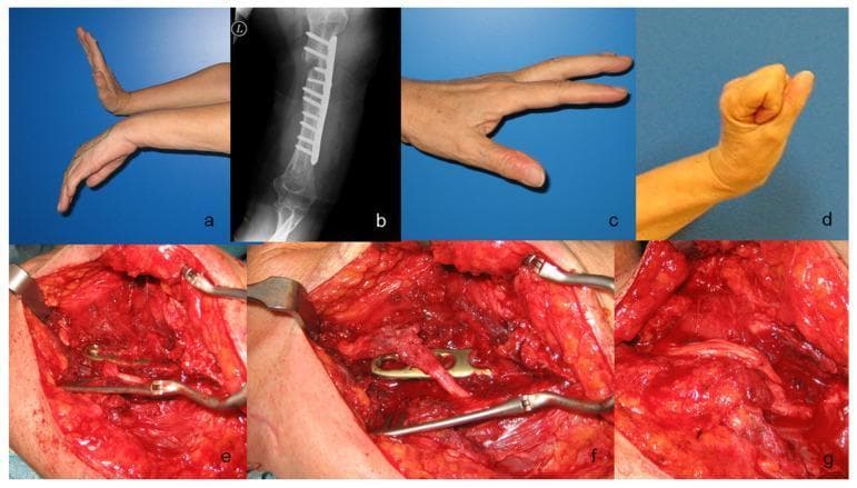 This composite figure illustrates a clinical case of radial nerve injury and subsequent surgical reconstruction following humeral fracture fixation. (a) Clinical photograph shows a classic preoperative 'wrist drop' deformity with inability to extend the wrist and fingers, characteristic of radial nerve palsy. (b) Anteroposterior radiograph demonstrates an osteosynthesis plate with multiple screws on the humeral shaft. (c, d) Postoperative photographs show successful functional recovery with active finger extension and wrist dorsiflexion. (e) Intraoperative view reveals the radial nerve severely compressed and pinched beneath the metallic humeral plate. (f) After removing a screw and elevating the plate, the nerve is found to be completely disrupted (neurotmesis). (g) Surgical reconstruction is shown using four cables of sural nerve grafts to bridge the 5 cm neural defect, secured with microsurgical sutures. This sequence demonstrates the identification, release, and grafting of a post-traumatic and iatrogenic nerve injury, highlighting the importance of clinical-radiographic correlation and microsurgical repair techniques in peripheral nerve surgery.