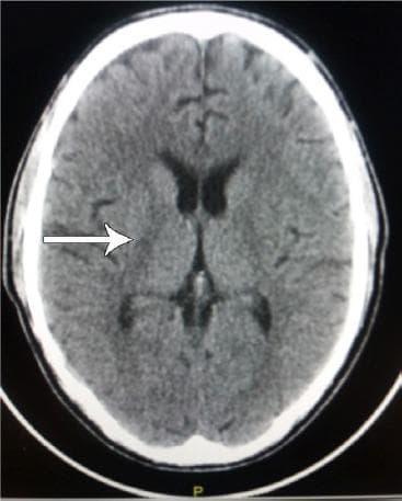 This diagnostic image is a non-contrast axial (transverse) computed tomography (CT) scan of the human brain. The scan displays the supratentorial anatomy, including the frontal, parietal, and occipital lobes, with visible lateral ventricles and the third ventricle along the midline. The brain parenchyma shows generally preserved symmetry with normal appearing sulci and gyri, indicating an absence of significant global atrophy or mass effect. A white arrow points to a focal, subtle hyperdensity located in the region of the basal ganglia, specifically involving the right putamen or globus pallidus area. This finding is clinically significant in the context of movement disorders, such as Parkinson's Disease (PD) or secondary parkinsonism, where vascular changes or calcifications in the basal ganglia may be relevant. The image serves as an educational example of neuroradiological assessment for focal density changes in patients presenting with progressive neurological symptoms.