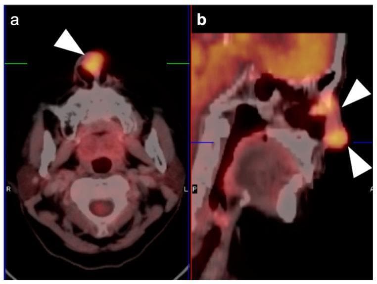 This diagnostic image displays FDG PET-CT scans of the head and neck, focusing on a sinonasal squamous cell carcinoma. Image (a) is an axial view showing a focal, intensely hypermetabolic tumor located at the anteroinferior nasal septum, indicated by a white arrowhead. The metabolic activity appears as a dense orange-to-yellow signal, signifying high glucose metabolism typical of malignancy. Image (b) is a sagittal reconstruction demonstrating the longitudinal spread of the tumor. The hypermetabolic activity extends throughout the entire nasal cavity, as highlighted by two white arrowheads, involving the nasal vestibule and spreading posteriorly along the nasal passages. This imaging modality combines the anatomical detail of computerized tomography (CT) with the functional metabolic data of positron emission tomography (PET), facilitating accurate staging and localization of sinonasal malignancies. The scans are critical for evaluating the extent of tumor invasion into adjacent sinonasal structures and planning surgical or radiation treatment.