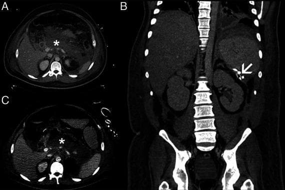 This composite diagnostic image features three panels (A, B, C) of a computerized tomography (CT) scan illustrating necrotizing pancreatitis and its management. Panels A and C are axial views showing extensive peripancreatic and retroperitoneal necrosis, marked by asterisks (*). The necrotic tissue appears as heterogeneous, mottled areas of low attenuation (density) surrounding the pancreatic head and body, extending into the retroperitoneal space anterior to the vertebral column and major vessels. Panel B is a coronal reformatted image demonstrating a transcutaneous drainage catheter (indicated by a white arrowhead) reaching the left retroperitoneum near the splenic hilum and the superior pole of the left kidney. This radiological series highlights a typical diagnostic and interventional approach for infected or symptomatic walled-off necrosis (WON) and acute necrotic collections. Key educational concepts include the recognition of pancreatic parenchymal destruction, retroperitoneal extension of inflammation, and the anatomical placement of minimally invasive percutaneous drains in the management of acute pancreatitis complications.