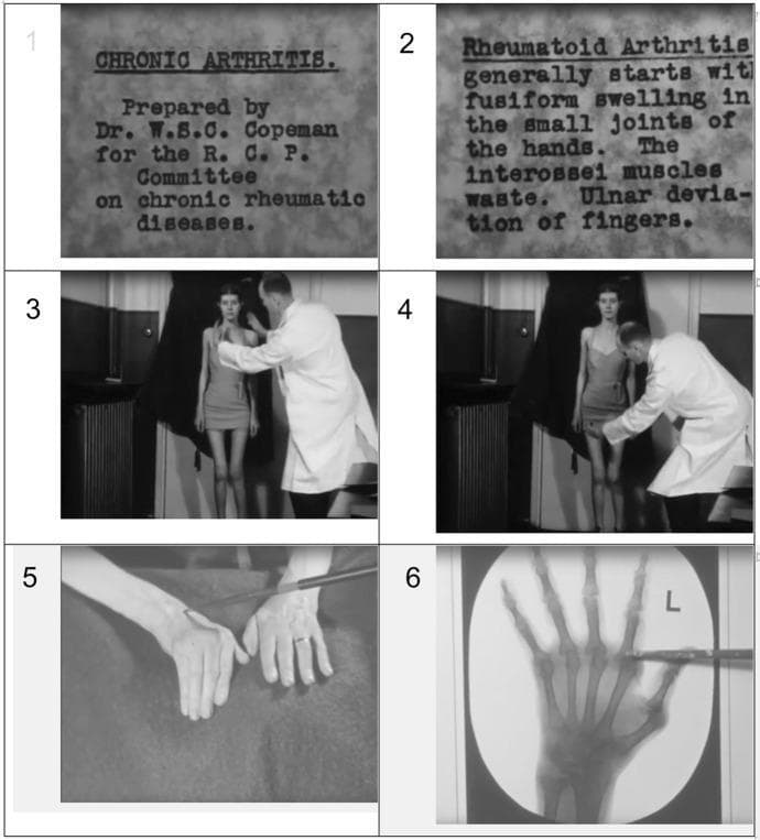This composite educational material consists of six stills from a historical medical film titled 'Chronic Arthritis' (1938), depicting clinical and diagnostic aspects of Rheumatoid Arthritis (RA). Panels 1 and 2 provide textual context, identifying RA features such as fusiform swelling of small hand joints, interossei muscle wasting, and ulnar deviation of the fingers. Panels 3 and 4 show a clinician in a white coat performing a physical examination on a standing patient, focusing on the shoulder/clavicular region and the knee joint, respectively, to assess range of motion and deformities. Panel 5 is a clinical photograph showing a close-up of a patient's hands with a pointer highlighting fusiform swelling and classic RA hand deformities. Panel 6 displays a diagnostic X-ray of the left hand, with a pointer indicating potential periarticular osteopenia or joint space narrowing in the metacarpophalangeal (MCP) or proximal interphalangeal (PIP) joints. This visual sequence is intended for medical education, demonstrating the transition from clinical signs to radiographic confirmation in rheumatology.