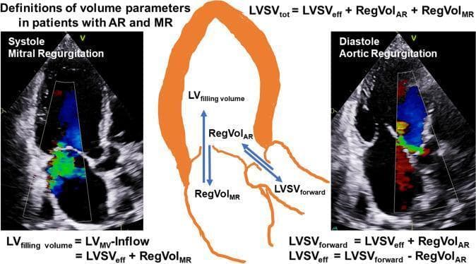 This educational image combines diagnostic echocardiography and an anatomical diagram to define left ventricular (LV) volume parameters in the context of combined valvular heart disease. The left panel shows a systolic color Doppler echocardiogram in an apical view, highlighting Mitral Regurgitation (MR). A mosaic-colored turbulent jet is visible originating from the mitral valve and entering the left atrium. The right panel displays a diastolic color Doppler echocardiogram demonstrating Aortic Regurgitation (AR), with a blue-red turbulent jet flowing from the aortic valve into the LV outflow tract. Centrally, a schematic illustration of the heart outlines blood flow vectors: RegVolMR (regurgitant volume through the mitral valve), RegVolAR (regurgitant volume through the aortic valve), and LVSVforward (forward stroke volume). Mathematical formulas define key hemodynamic concepts, including LV filling volume, total LV stroke volume (LVSVtot), and effective stroke volume (LVSVeff). This material is designed for intermediate to advanced medical learners to understand the complex volume dynamics and echocardiographic assessment of interdependent valvular lesions.