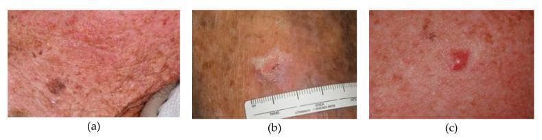 This clinical photograph set presents a side-by-side comparison of three distinct types of skin cancer lesions labeled (a), (b), and (c). Image (a) demonstrates malignant melanoma, characterized by an irregularly pigmented, dark brown to black macule situated on a background of sun-damaged, erythematous skin with a rough texture and multiple small papules. Image (b) shows a squamous cell carcinoma (SCC), presenting as a raised, scaly, flesh-colored plaque with an irregular border and central crusting; a clinical ruler is included for scale. Image (c) displays a basal cell carcinoma (BCC), visible as a small, well-circumscribed, pearly erythematous nodule with possible central ulceration. This comparison chart is designed for medical education to assist in the clinical differentiation of primary skin malignancies based on morphology, color, and surface characteristics. Key concepts illustrated include lesion asymmetry, border irregularity, and characteristic tissue changes associated with different histopathological subtypes of skin cancer.