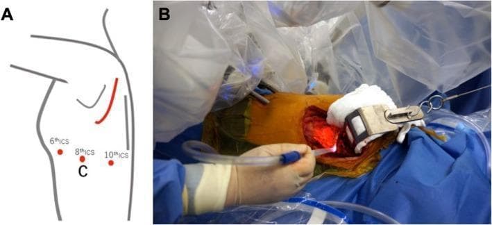 Educational composite figure demonstrating surgical planning and intraoperative execution for Robotic-Assisted Thoracic Surgery (RATS). Panel A is a schematic anatomical diagram of the left posterolateral chest wall. Red circles indicate specific port placements at the 6th, 8th, and 10th intercostal spaces (ICS), with the 8th ICS marked 'C' to denote the camera port. A curved red line indicates the site for a posterior skin incision required for chest wall resection. Panel B is a clinical photograph of the intraoperative field with the da Vinci surgical system docked. The surgical site is prepared with povidone-iodine and bordered by blue sterile drapes. Robotic arms encased in sterile plastic draping are positioned over the patient. A surgeon's hand is seen manipulating a clear suction/irrigation tube near the thoracotomy opening, which is illuminated by a red light source. A metal retractor is visible at the edge of the incision, which exposes the underlying muscle and rib tissue involved in the resection of a posterior mediastinal mass.