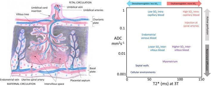 A composite medical illustration and graph depicting placental anatomy and related MRI biophysical properties.
The left panel is a detailed anatomical diagram of a human placenta at approximately 32 weeks gestation. It illustrates the fetal circulation, including the umbilical cord (vein and arteries), chorionic plate, and the branching villous tree. The maternal circulation is shown via the basal plate, uterine spiral arteries, endometrial veins, and the intervillous space. The diagram highlights the proximity of maternal and fetal blood vessels at the exchange surface, separated by placental septa.
The right panel is a bivariate plot used for diagnostic imaging analysis. The x-axis represents T2* relaxation time (ms) at 3T, a proxy for tissue oxygenation (SO2), ranging from deoxyhemoglobin to oxyhemoglobin. The y-axis represents the Apparent Diffusion Coefficient (ADC, mm²/s) on a logarithmic scale, indicating water mobility (restricted diffusion vs. active perfusion). Various placental tissue environments, such as septal walls, myometrium, and intervillous blood, are mapped onto the plot based on their specific oxygenation and diffusion characteristics, serving as a model for interpreting combined diffusion-relaxation MRI data.