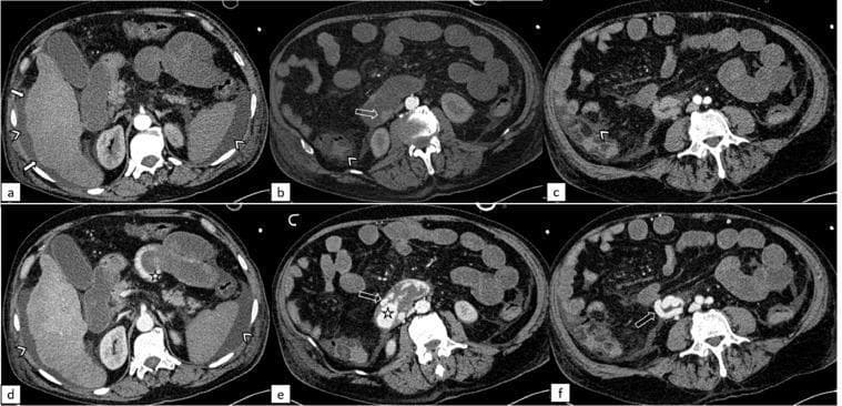 Contrast-enhanced axial computed tomography (CT) images of the abdomen displaying a comparison between the arterial phase (top row, a-c) and the venous/portal phase (bottom row, d-f). The images demonstrate hallmark features of liver cirrhosis and portal hypertension. Key findings include an irregular liver contour with surface undulations (white arrows) and significant ascites (arrowheads) manifesting as low-attenuation fluid in the perihepatic and perisplenic spaces. In the portal phase (d-f), there is a prominent, dilated, and tortuous ectopic venous varix located in the third section of the duodenum (empty arrows). High-attenuation contrast leakage (star) within the duodenal lumen in the portal phase indicates active intraluminal bleeding. The images effectively contrast the differential enhancement of hepatic parenchyma and the progressive visualization of venous structures and hemorrhage between phases. This clinical imaging set is highly relevant for medical education on the complications of portal hypertension and the diagnostic utility of multi-phase CT in identifying ectopic variceal bleeding.