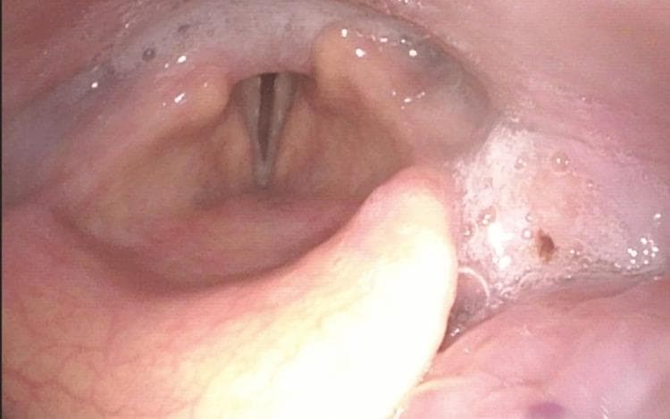 This diagnostic endoscopic image (flexible fiberoptic laryngoscopy) provides a superior view of the larynx, specifically focusing on the glottic aperture and surrounding supraglottic structures. The clinical finding demonstrates bilateral vocal cord paralysis (BLVCP) in a resting state. Anatomically, the right arytenoid is positioned medially, while the left arytenoid appears slightly more lateral, resulting in an asymmetric, persistent glottic gap between the vocal folds. A significant finding is the presence of salivary pooling within the pyriform sinuses and laryngeal vestibule, which is often clinically indicative of impaired swallowing mechanics or pharyngeal phase dysphagia secondary to laryngeal immobility. The epiglottis is partially visible in the foreground, and the true vocal folds appear pale and fixed in their respective positions. This image is an educational example of neurogenic laryngeal dysfunction, illustrating the structural manifestations of recurrent laryngeal nerve compromise and the associated risk of aspiration as evidenced by secretion management difficulties.