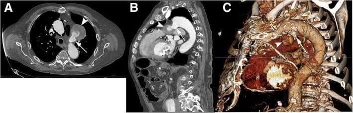 This composite of contrast-enhanced computed tomography angiography (CTA) images of the thoracic aorta illustrates a ductus arteriosus diverticulum (DAD) and an associated pseudoaneurysm. Panel A, an axial image, shows the DAD (arrow) as a contrast-filled outpouching from the aorta, connecting to a larger, more peripheral pseudoaneurysm (arrowhead) that displays heterogeneous density, indicating a mix of opacified blood and potential thrombus. Panel B is a two-dimensional sagittal reformatted image showing the DAD (arrow) and pseudoaneurysm (arrowhead) arising from the inferior aspect of the aortic arch, near the site of the ligamentum arteriosum. Panel C presents a three-dimensional volume-rendered reconstruction, providing a spatial overview of the aortic arch anatomy for surgical planning. The reconstruction clearly delineates the wide neck of the DAD (arrow) and the orientation of the pseudoaneurysm sac (arrowhead) toward the pulmonary artery. These images demonstrate key diagnostic features used to differentiate a benign ductus diverticulum from a complex vascular pathology requiring intervention.