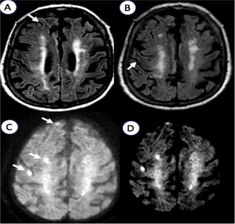 This diagnostic imaging panel presents axial brain MRI sequences from a patient with nonketotic hyperglycemic hyperosmolar state (NKHHS). Panels A and B are T2-FLAIR sequences showing multifocal, subcortical hypointensities predominantly in the right hemisphere's white matter. These areas (marked with arrows) demonstrate decreased signal intensity compared to adjacent brain parenchyma. Panel C illustrates Diffusion-Weighted Imaging (DWI), revealing disseminated hyperintense cortical lesions in the right frontal region. Panel D shows the corresponding Apparent Diffusion Coefficient (ADC) map, where these same regions exhibit signal loss (restricted diffusion). The combination of high DWI signal and low ADC signal indicates cytotoxic edema. These findings are characteristic of hyperglycemia-induced brain injury, where metabolic derangement and hyperosmolarity lead to transient neurological deficits and specific neuroimaging patterns, often localized to the subcortical white matter and overlying cortex.