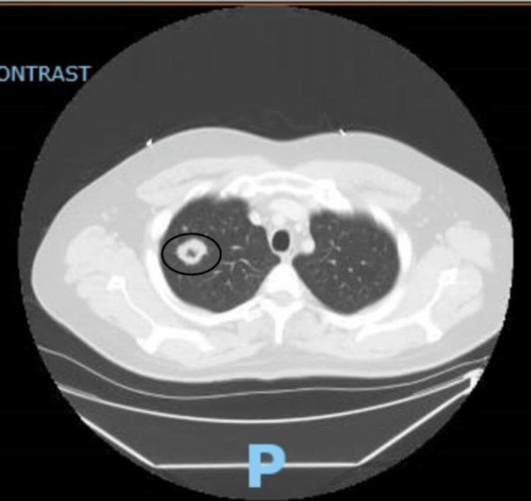 This diagnostic image is an axial non-contrast computed tomography (CT) scan of the upper chest. The primary finding is a solitary, well-defined cavitary nodule located in the right upper lobe of the lung, highlighted by a black circular annotation. The lesion exhibits a relatively thick, irregular wall with a lucent, air-filled central cavity, measuring approximately 2.9 cm in maximum diameter. The surrounding lung parenchyma appears largely unremarkable without evidence of significant consolidation or pleural effusion. Anatomical landmarks including the trachea, apical mediastinum, and ribs are visible and intact. Clinically, this radiographic presentation in a patient with positive c-ANCA titers is highly characteristic of Granulomatosis with Polyangiitis (GPA), formerly known as Wegener's granulomatosis. This image serves as a classic educational example for differential diagnosis of cavitary lung lesions, which includes GPA, tuberculosis, fungal infections, and malignancy.