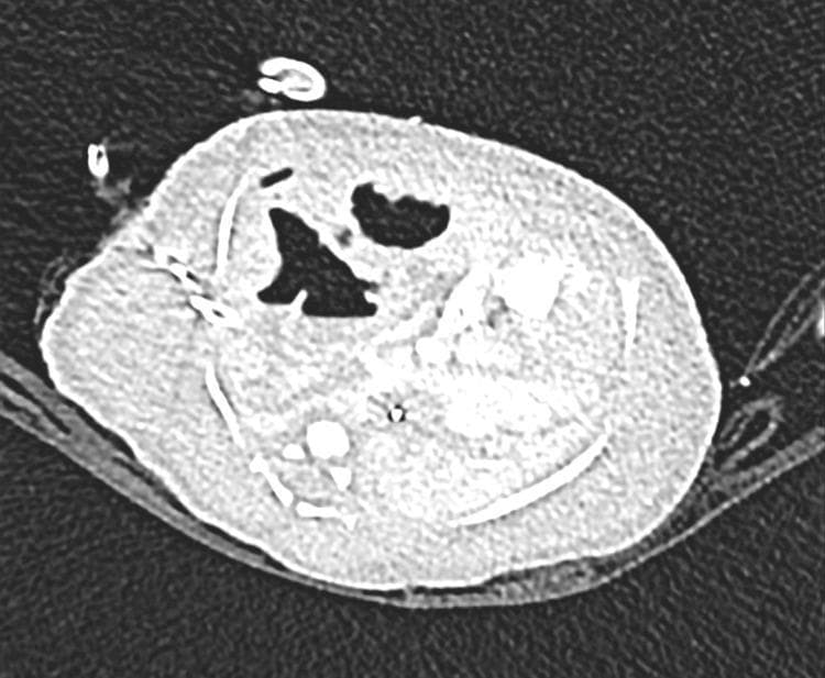 This axial chest computerized tomography (CT) scan of a newborn demonstrates a large congenital cystic airway malformation (CPAM) predominantly occupying the right middle lobe. The lesion is characterized by multiple air-filled cystic spaces of varying sizes and irregular morphology, surrounded by soft tissue density. A significant mass effect is evident, causing a prominent contralateral (leftward) mediastinal shift and compression of the adjacent pulmonary parenchyma. The CT scan also captures the presence of medical hardware, including an external chest drain on the right side and endotracheal/vascular access lines, consistent with neonatal intensive care management. This diagnostic image illustrates a Type 1 CPAM with invasive mucinous features, emphasizing its clinical significance in causing severe neonatal respiratory and cardiovascular instability through space-occupying displacement of vital thoracic structures.